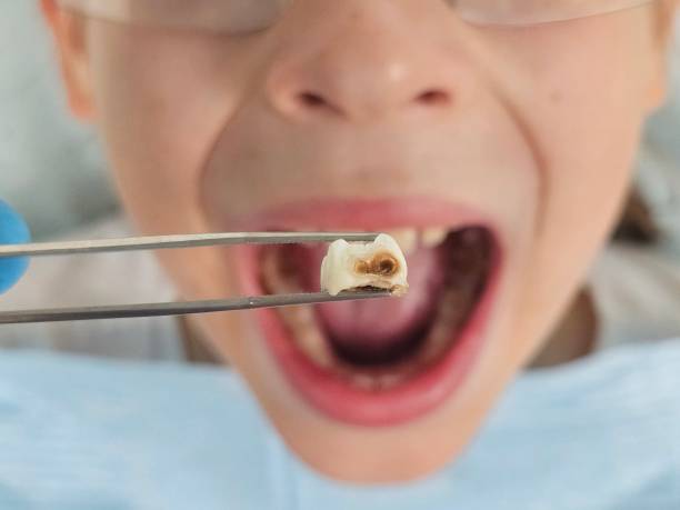 Best Emergency Dentist for Knocked-Out Tooth in Sammamish, WA
