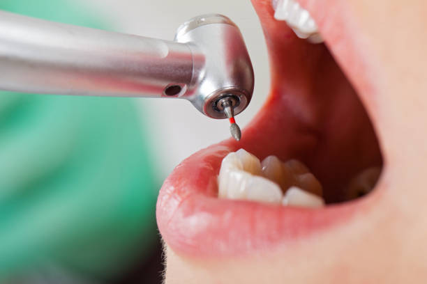 Best Broken or Cracked Tooth Emergency Dentist in Sammamish, WA